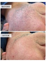 ルアナラウンジ(Luana Lounge)/【症例】　美容電気脱毛　ヒゲ