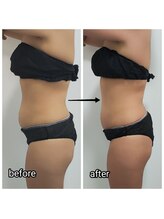 ビー アンド エイチ(B&H)/インディバボディ（３回施術）