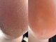 グリーム(GREEM)の写真/【触りたくなる足裏ケア！】乾燥・ひび割れなど足のトラブルお任せ下さい◎感動するツルすべかかとに♪