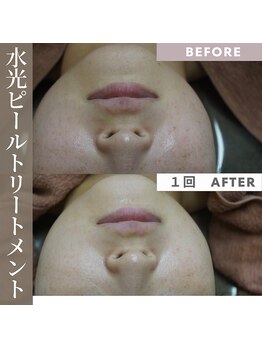 アップルミント/<フェイシャル>before・after