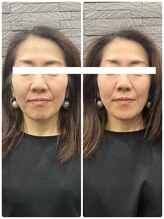 長寿鍼灸院 長寿整骨院/美容鍼50本の効果★リフトアップ