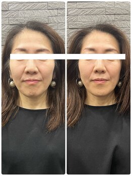 長寿鍼灸院 長寿整骨院/美容鍼50本の効果★リフトアップ