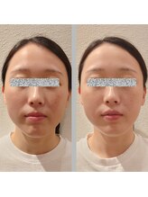 カモン(KAMON)/美顔矯正1回目