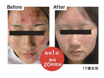 ノリスズ(NORI SUZU)/医師監修.ヒト幹細胞導入１回