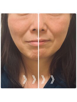 レモンローズ(Lemon Rose)/ボキボキしない小顔矯正