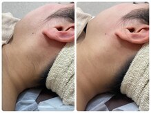 エクボ(EcBeau)/うなじ脱毛といえばエクボ!