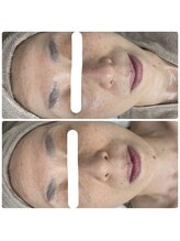 ソフィア わさだ店/60代セルマン肌質改善15回