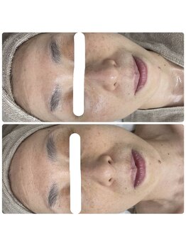 ソフィア わさだ店/60代セルマン肌質改善15回