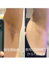 ワイズサロン(Y's salon)/自分のワキで検証(^ ^)