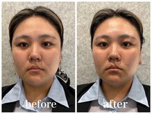 ルー ハナレ 神戸岡本 摂津本山店(Luu HANARE)/Luuスタッフ１回目リフトアップ