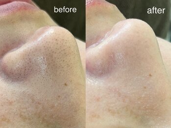 テオリア(TEORIA)/最強エイジングケアコース☆