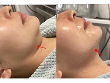 ホワイティアビシェル 浦和(Whitia Vishell)/小顔フェイスラインクッキリ