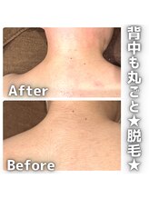 グルーミー(gloomy)/背中も丸ごと！脱毛♪