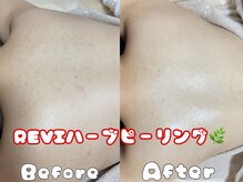 グラシア 倉敷店(Gracia)の雰囲気(背中のブツブツ/二の腕のブツブツにもおすすめ◎)