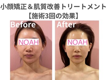 ノア 川越店(NOAH)/小顔矯正＆肌質改善
