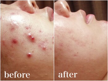 アワピール 成田公津の杜店(AWA PEELL)/ハーブピーリングでニキビケア