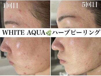 ホワイトアクア 京橋店(WHITE AQUA)/ハーブピーリング/ニキビケア