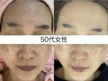 サクラ 伊勢原店(SAKURA)/大人のシミ改善