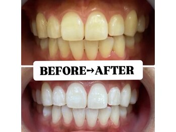 ホワイトニングサロン 豊中/Before&After美白ホワイトニング