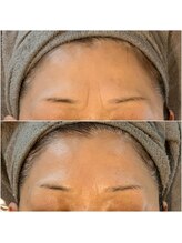 タオ(TAO)/眉間のシワ改善（50代）