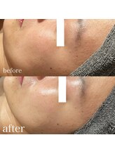 ナーズ(NAZ)/ララピール