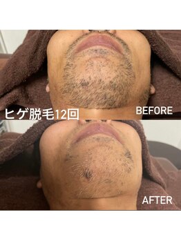 ココ(Coco)/ヒゲ脱毛12回：ビフォーアフター