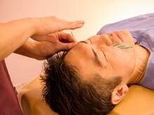 アルト(alto)/メンズ美容鍼！目の疲れにも！