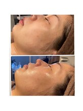 ベルフルール 西18丁目店/ハーブピーリング