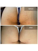 ビビ(VIVI)/ララピール・ハーブピーリング