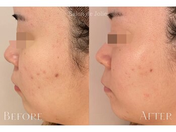 サロンドジョリー(Salon de Jolie)/ハーブピーリング→AEMILIA導入