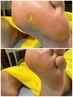 【プロにお任せ！】魚の目/たこケア45分￥5,000