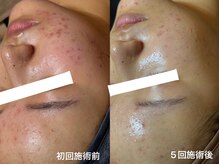 ゼニス 池袋本店(ZENITH)/肌荒れ改善の決定版◎セラピール