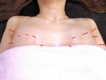 一丁目治療院/美乳鍼