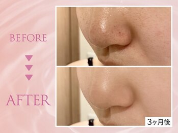 クリアラボ 池袋2nd(Clear Lab)/韓国肌管理&毛穴洗浄専門店