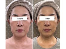 アリィ(Alii)/中顔面短縮で若見え！