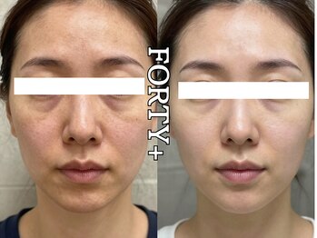 フォーティープラス(FORTY+)/施術事例