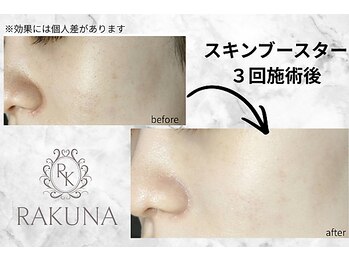 ラクナ(RAKUNA)/スキンブースター/肌管理/白玉肌