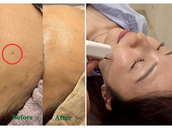 ピュアボディ(Pure Body)の写真/今秋のシミ対策!夏に濃くなったシミ・蓄積シミに◎【30分間シミケア放題★￥4980】気になる部分を好きなだけ