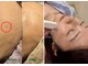 ピュアボディ(Pure Body)の写真/今秋のシミ対策!夏に濃くなったシミ・蓄積シミに◎【30分間シミケア放題★￥4980】気になる部分を好きなだけ