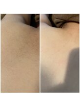 ボンダイボディー(Bondi Body)/小学生の背中脱毛