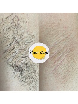 ハニ ラニ(Hani Lani)/“両脇”ダブル脱毛