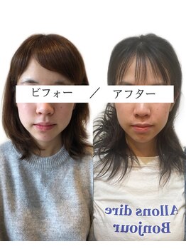 長寿鍼灸院 長寿整骨院/美容鍼50本の効果★小顔効果