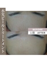 アップルミント/＜フェイシャル＞before・after