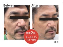 ノリスズ(NORI SUZU)/エクソソーム×神経.脂肪由来