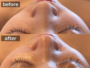 ルナステラ 金沢店/ハイドロ毛穴洗浄