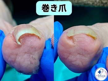 プラスワンフット 本厚木(+1 Foot)/巻き爪矯正は専門店へ●