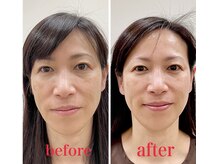 はり灸八角堂/美容鍼before/after