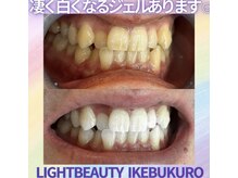 ライトビューティー 池袋店(LightBeauty)/症例写真