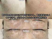 パイシーズ(Pisces)の雰囲気（瞼の上のシミも施術できますよ！）