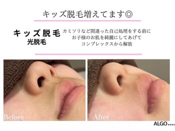 アルゴ 豊中岡町駅前店(ALGO)/【キッズ脱毛】